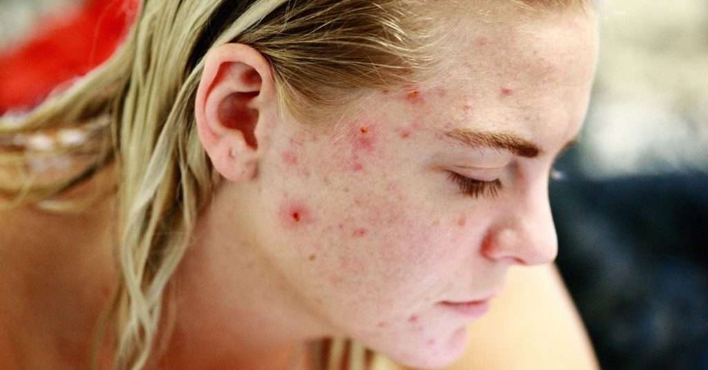 causes of acne on the face